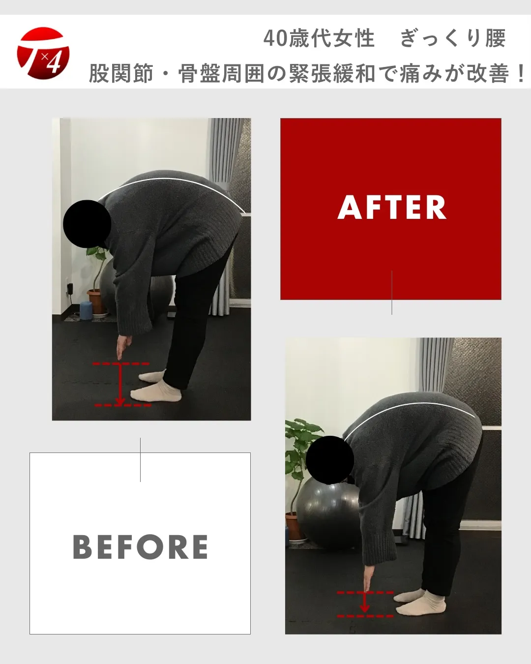 40歳代女性　ぎっくり腰