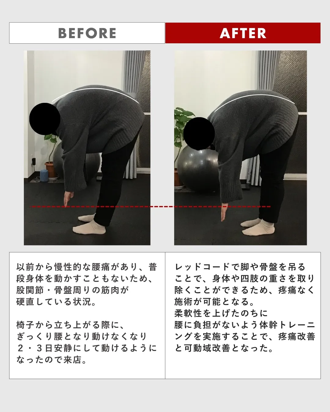 40歳代女性　ぎっくり腰